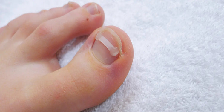 Pack de Démarrage pour Orthonyxie - Bandes + Colle + Pince - Podostripe