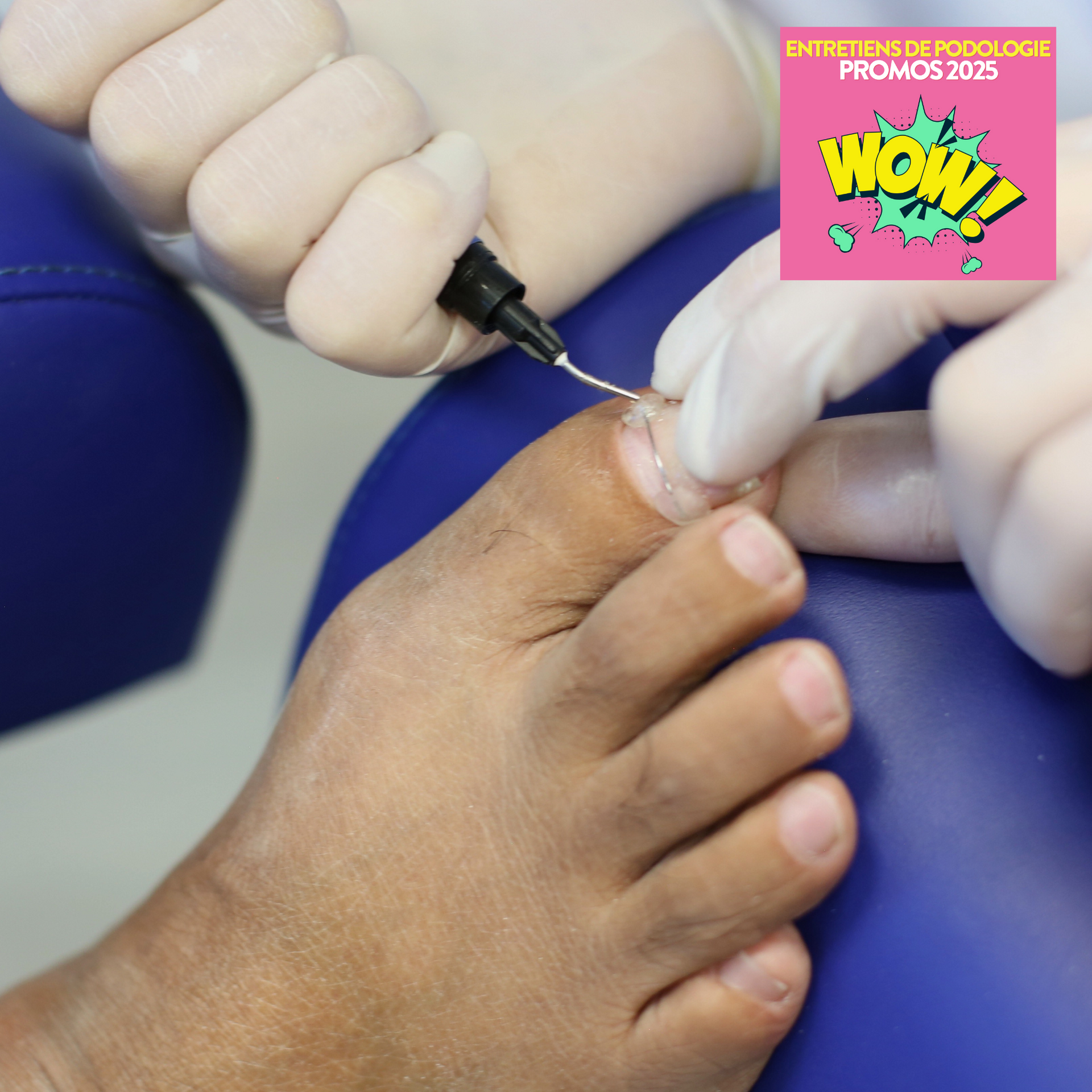 Orthoplasties-et-orthonyxies-10-ans-My-Podologie My Podologie
